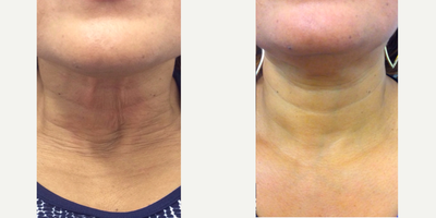 Botox before and after photo
