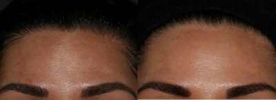 Moxi before and after photo