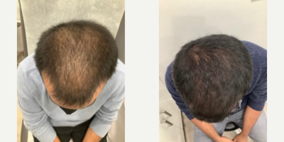 Botox before and after photo