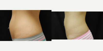 CoolSculpting before and after photo