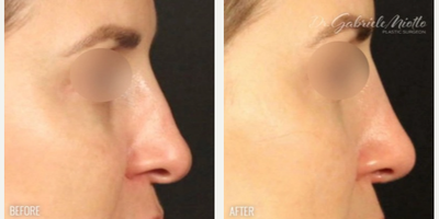 Rhinoplasty before and after photo