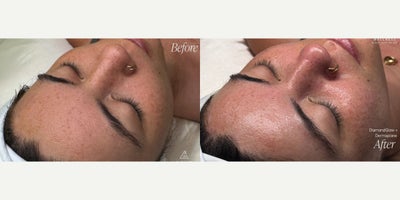 DiamondGlow before and after photo