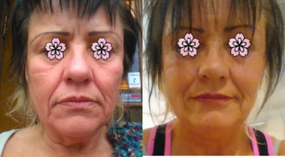 Facelift before and after photo