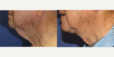 Neck Lift before and after photo