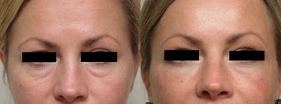 Eyelid Surgery before and after photo