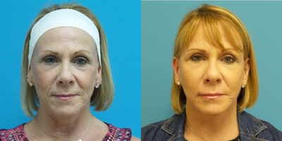 Facelift before and after photo