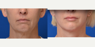 Lip Fillers before and after photo