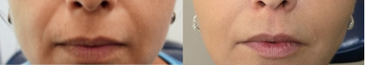 Lower Facelift before and after photo