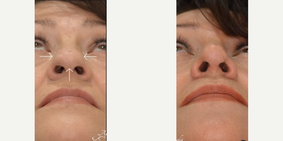Rhinoplasty before and after photo