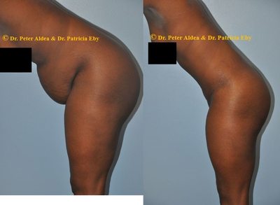 Tummy Tuck before and after photo