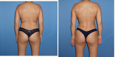 Vaser Liposuction before and after photo