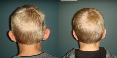 Ear Surgery before and after photo