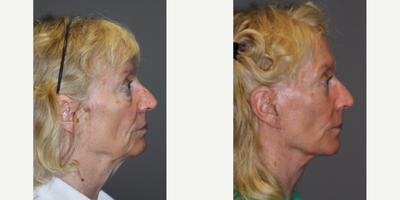 Eyelid Surgery before and after photo