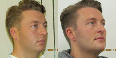 Genioplasty before and after photo
