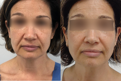 Halo Laser before and after photo