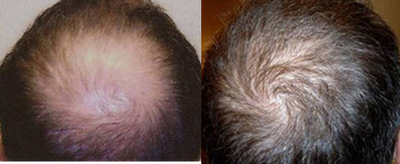 NeoGraft before and after photo