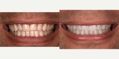 Porcelain Veneers before and after photo