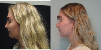 Rhinoplasty before and after photo