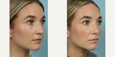 Rhinoplasty before and after photo