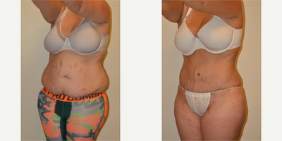 Tummy Tuck before and after photo