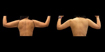 Arm Lift before and after photo