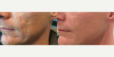 Bellafill before and after photo