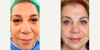 Eyelid Retraction Repair before and after photo