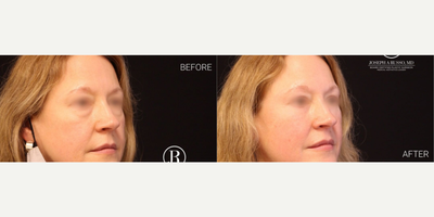 Eyelid Surgery before and after photo