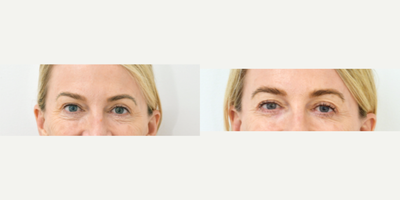 Eyelid Surgery before and after photo
