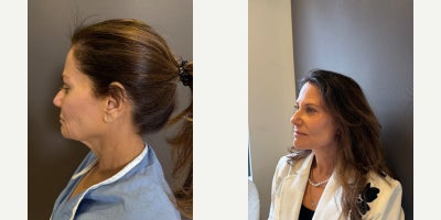 Facelift before and after photo
