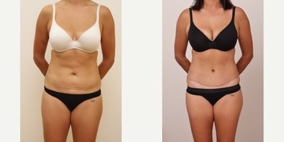 Tummy Tuck before and after photo