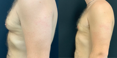 Gynecomastia Surgery before and after photo