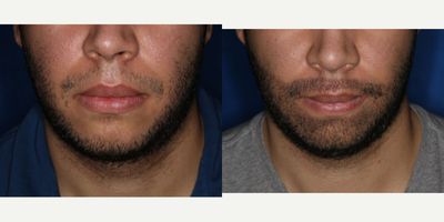Beard Transplant before and after photo