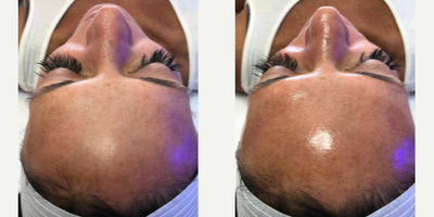 HydraFacial before and after photo