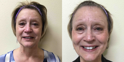Juvederm before and after photo