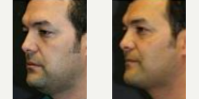 Liposuction before and after photo