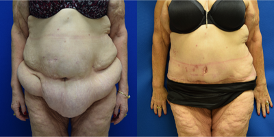 Panniculectomy before and after photo