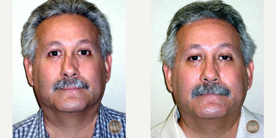 Revision Rhinoplasty before and after photo