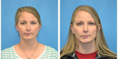 Revision Rhinoplasty before and after photo