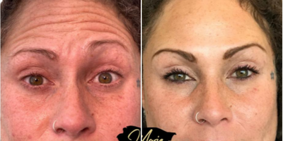 Botox before and after photo