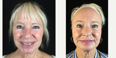 CO2 Laser before and after photo