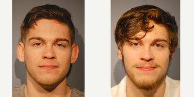 Ear Surgery before and after photo