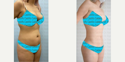 Liposuction before and after photo
