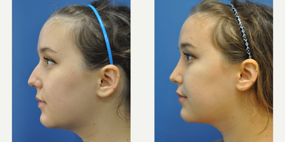 Rhinoplasty before and after photo