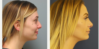 Rhinoplasty before and after photo