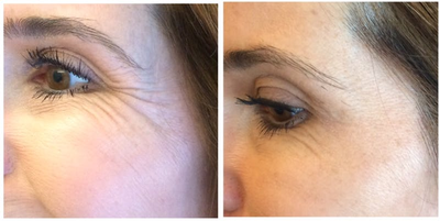 Botox before and after photo