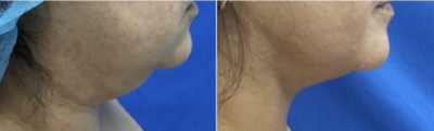 Chin Liposuction before and after photo