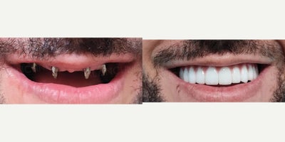 Dental Implants before and after photo