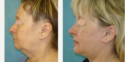 Facelift before and after photo