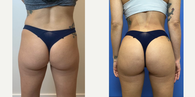 Liposuction before and after photo